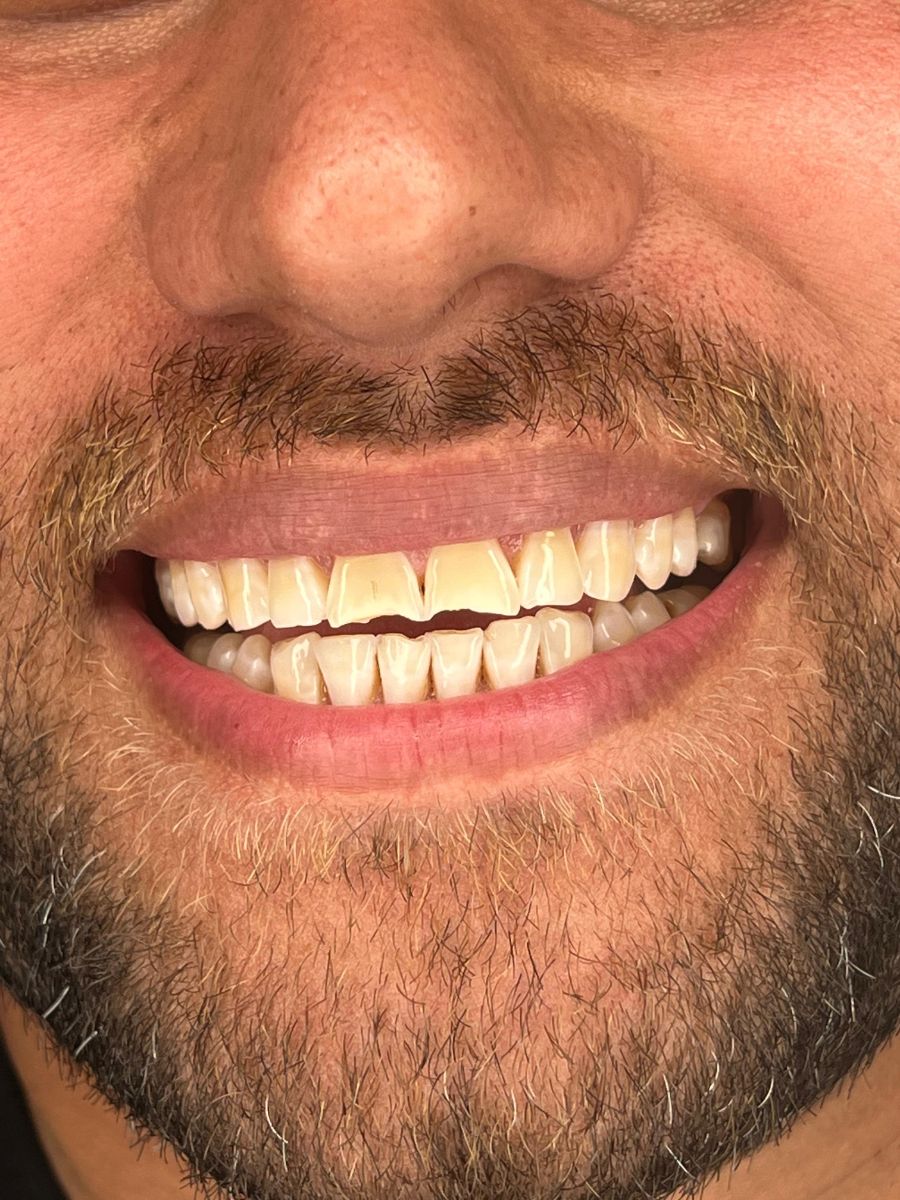 Porcelain veneers, before treatment