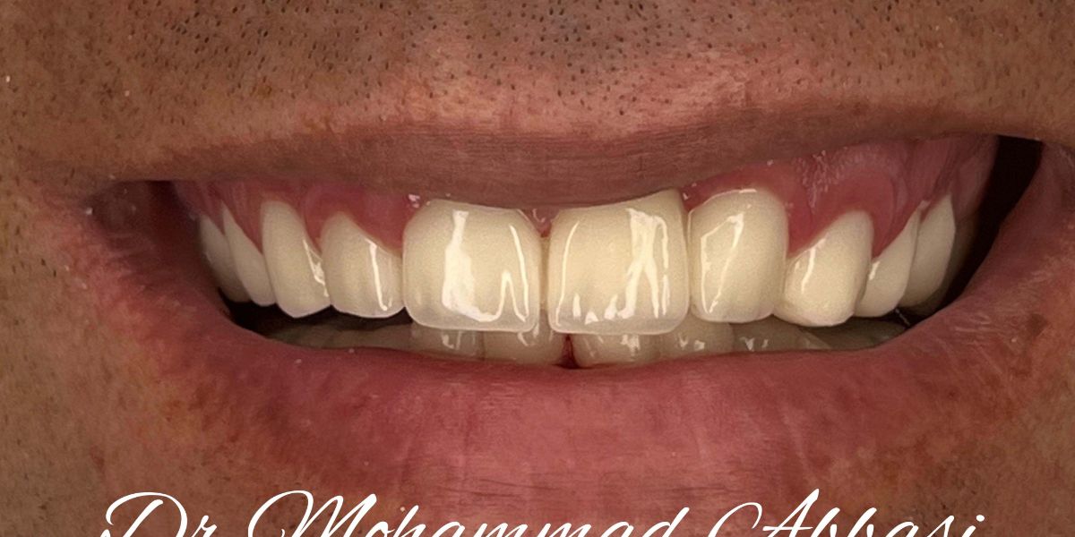 Porcelain veneers case 15, after treatment