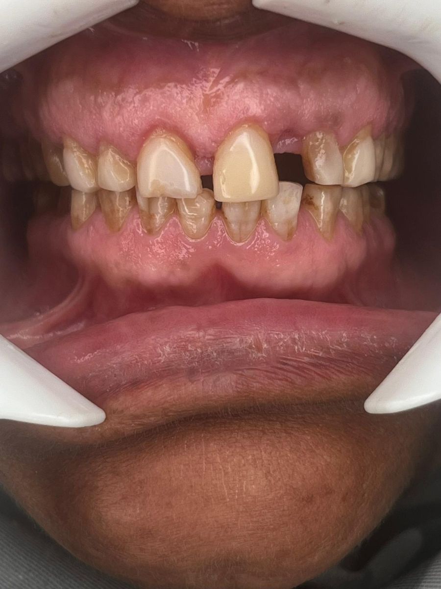Porcelain veneers, before treatment