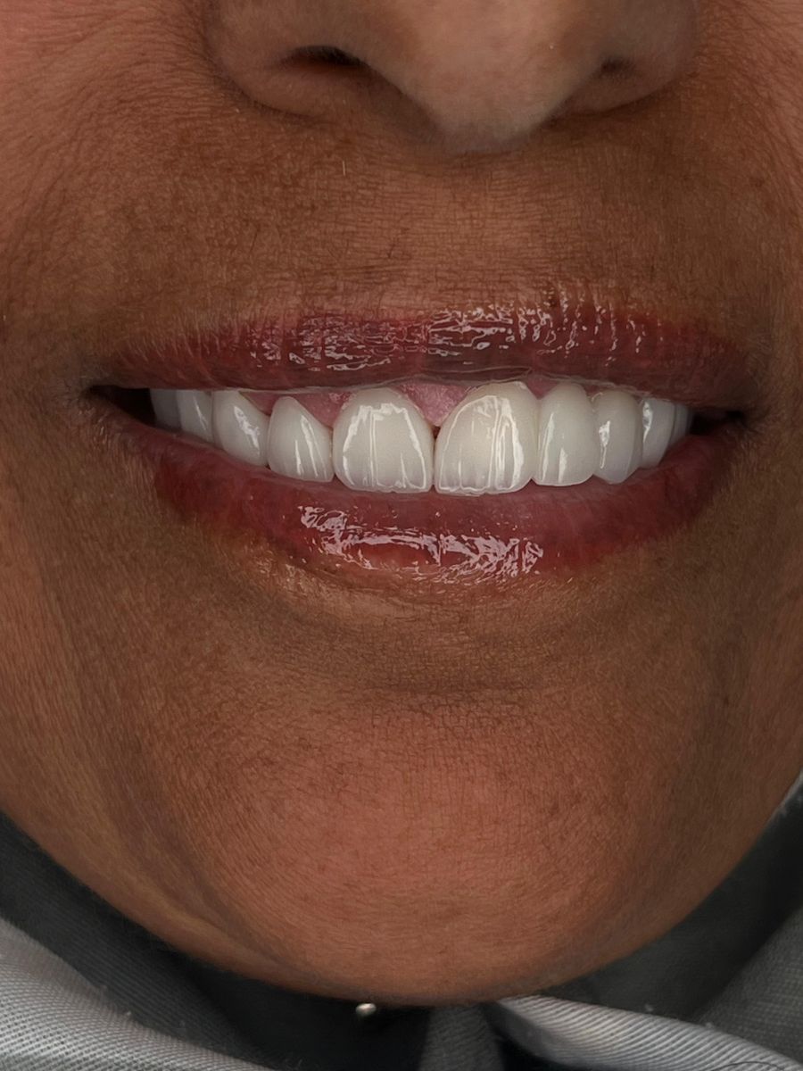 Porcelain veneers, after treatment