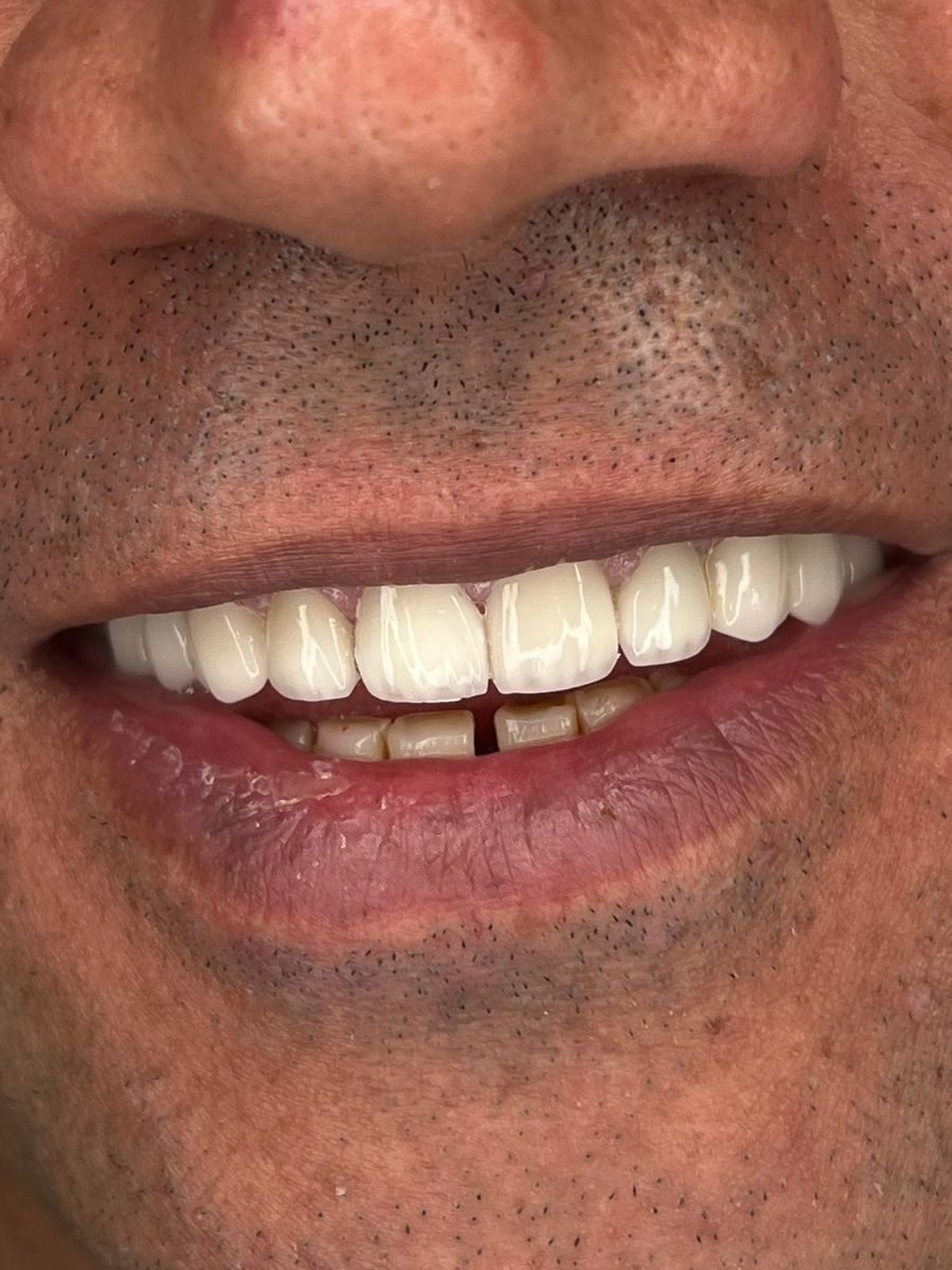 Porcelain veneers case 3, after treatment