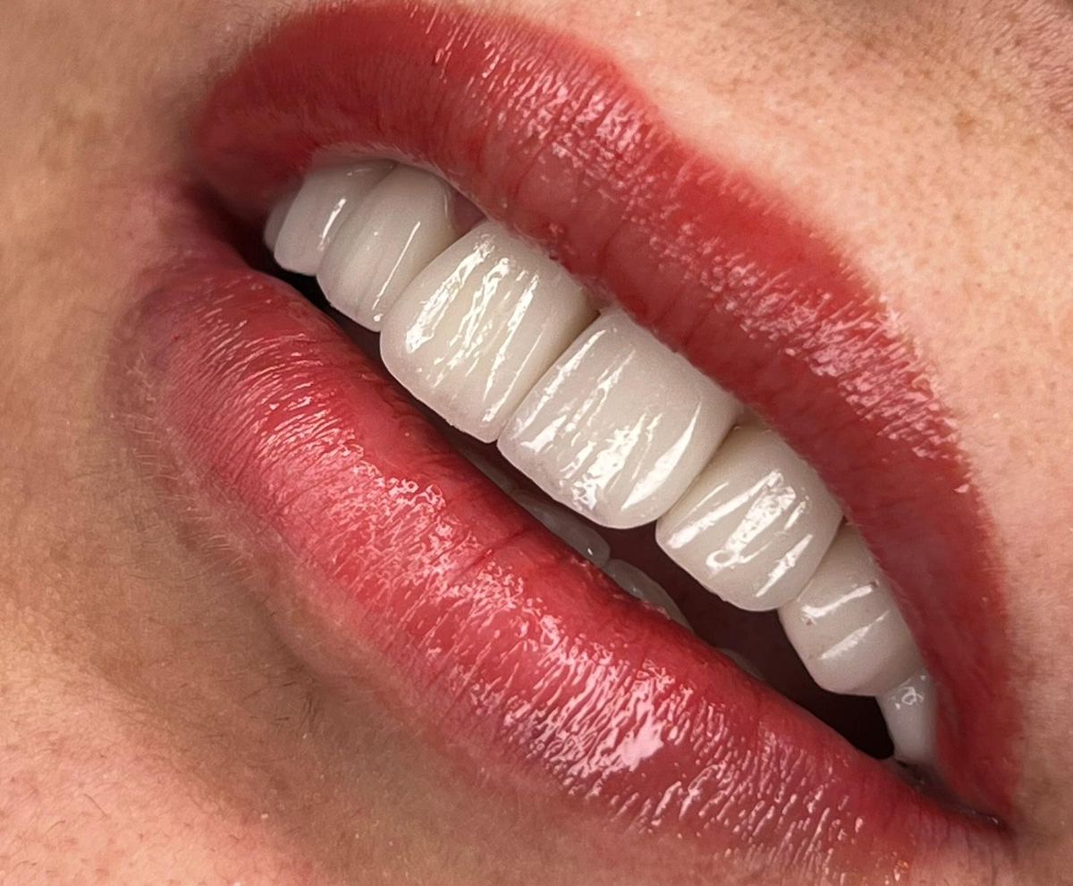 Porcelain veneers case 5, after treatment