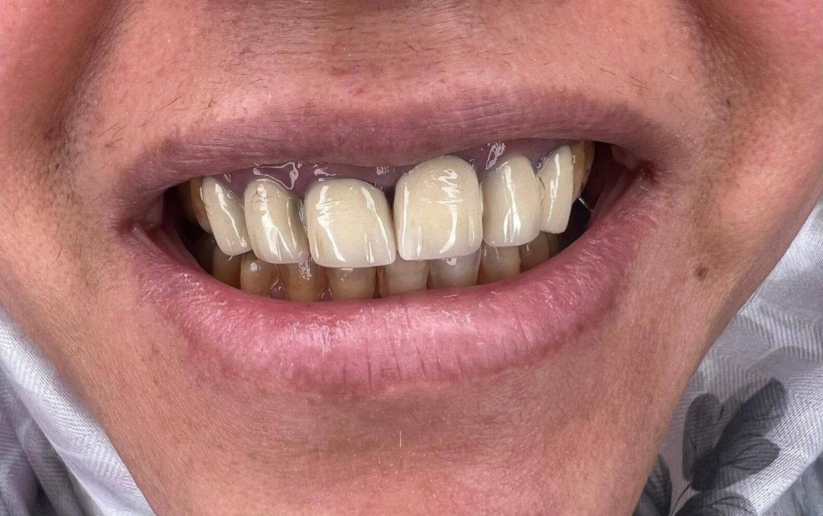 Porcelain veneers, before treatment