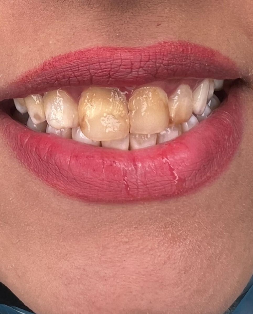Porcelain veneers, before treatment