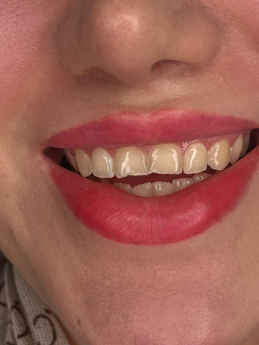Composite bonding, before treatment