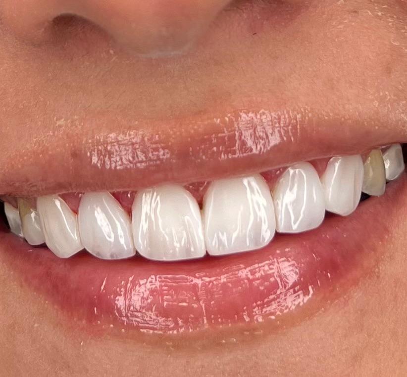 Composite bonding, after treatment