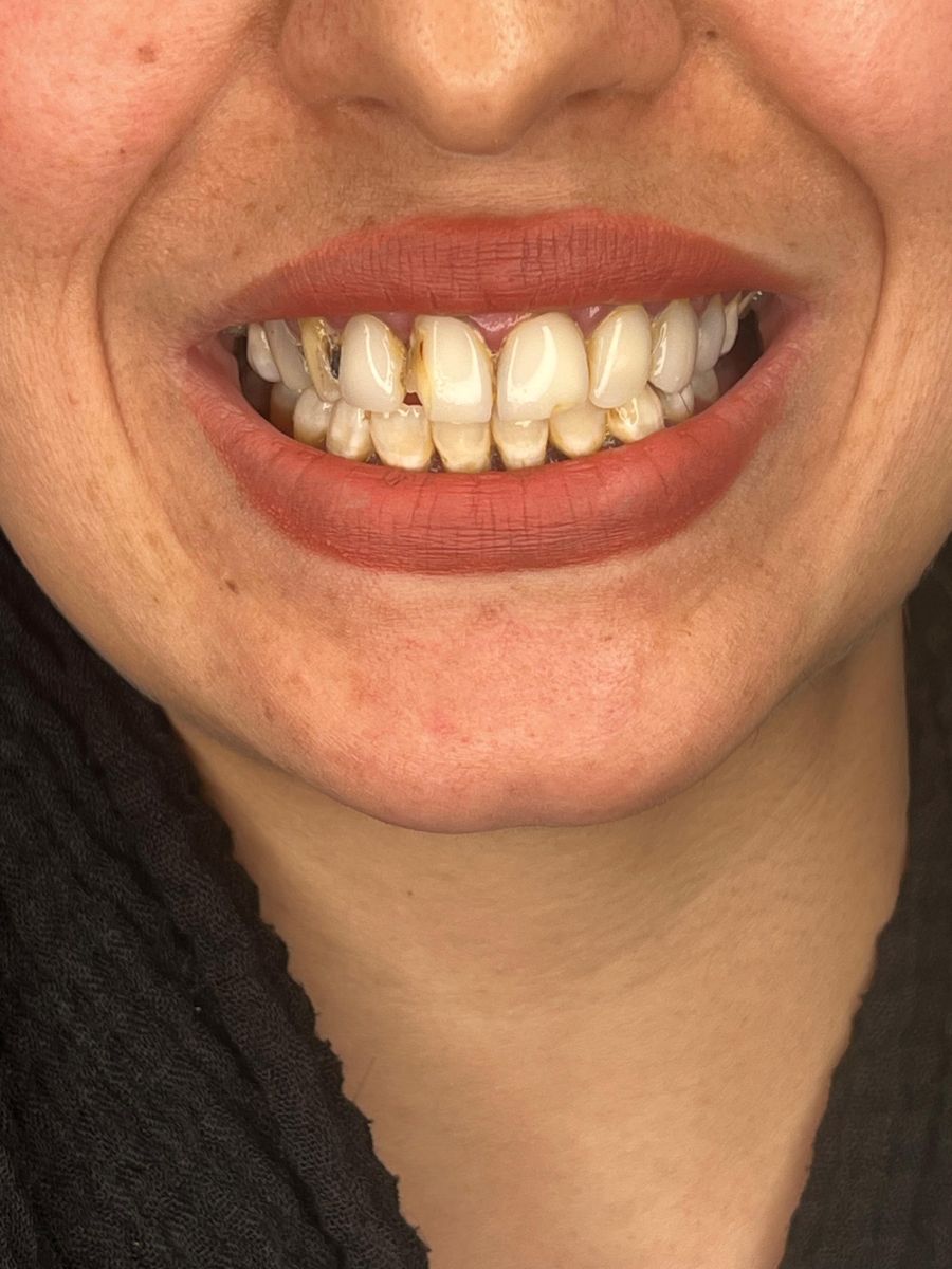 Composite bonding case 3, before treatment