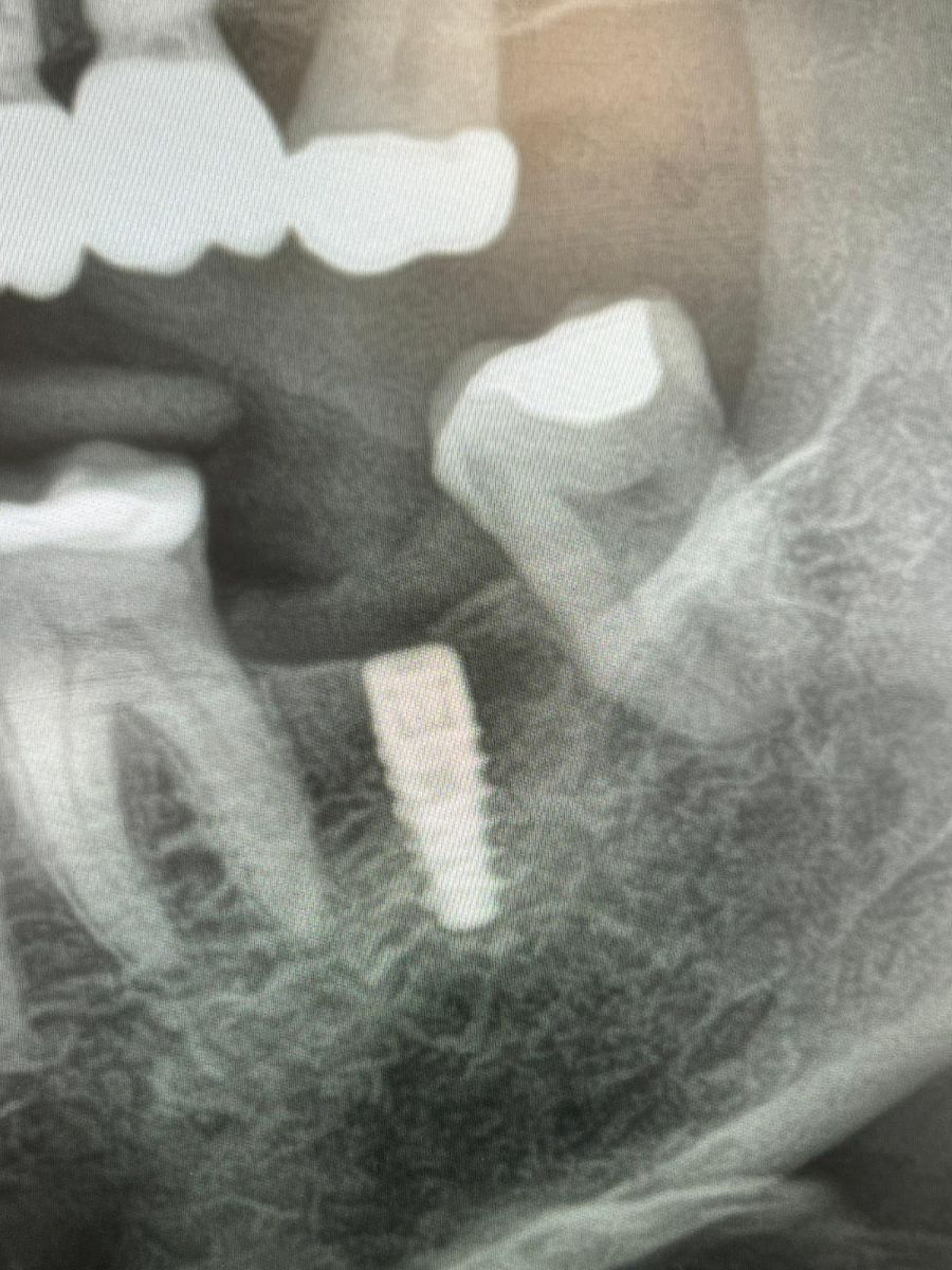 Dental implant case 2, stage 2 of 3
